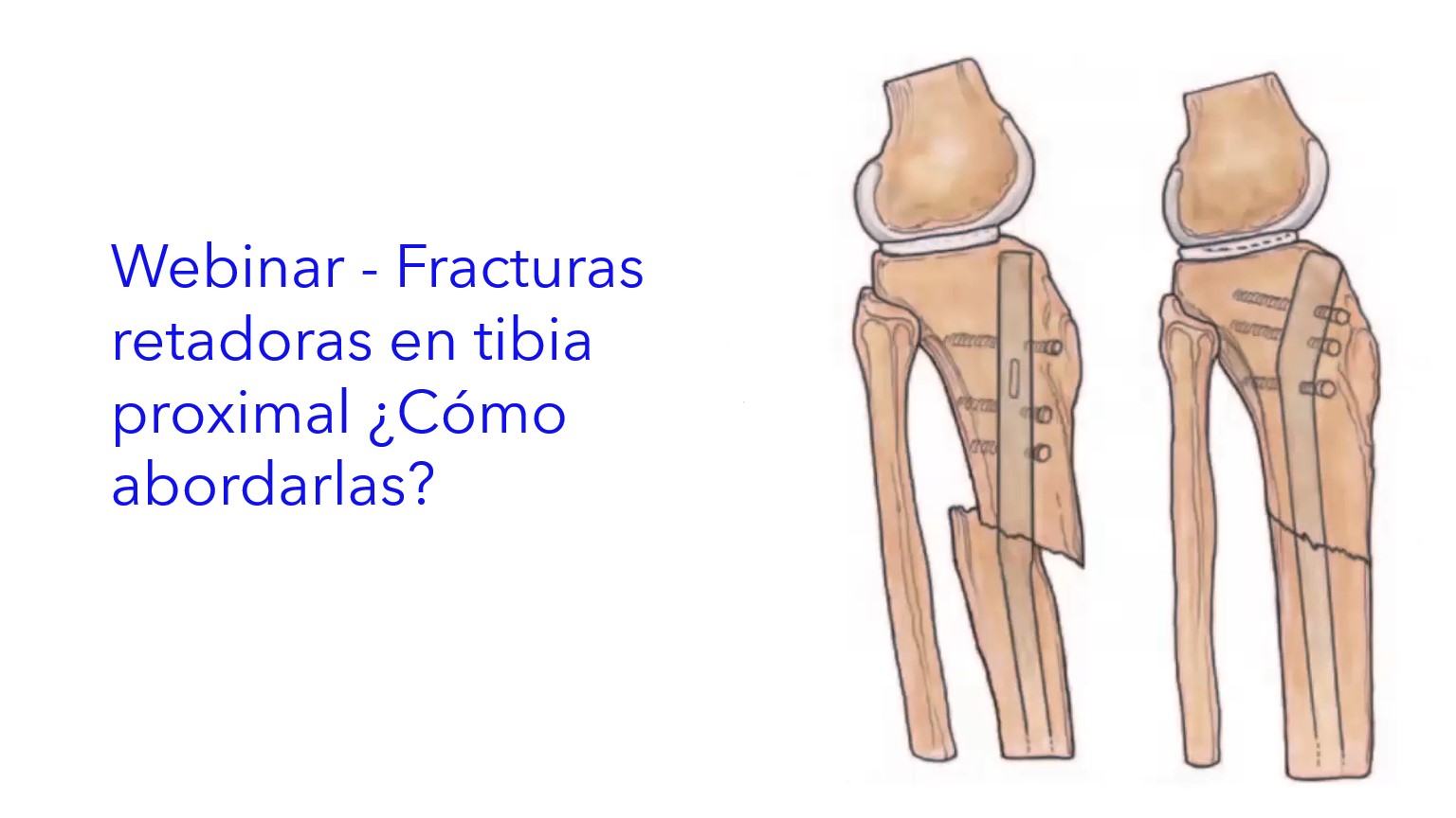Webinar - Fracturas retadoras en Tibia Proximal ¿Cómo abordarlas?