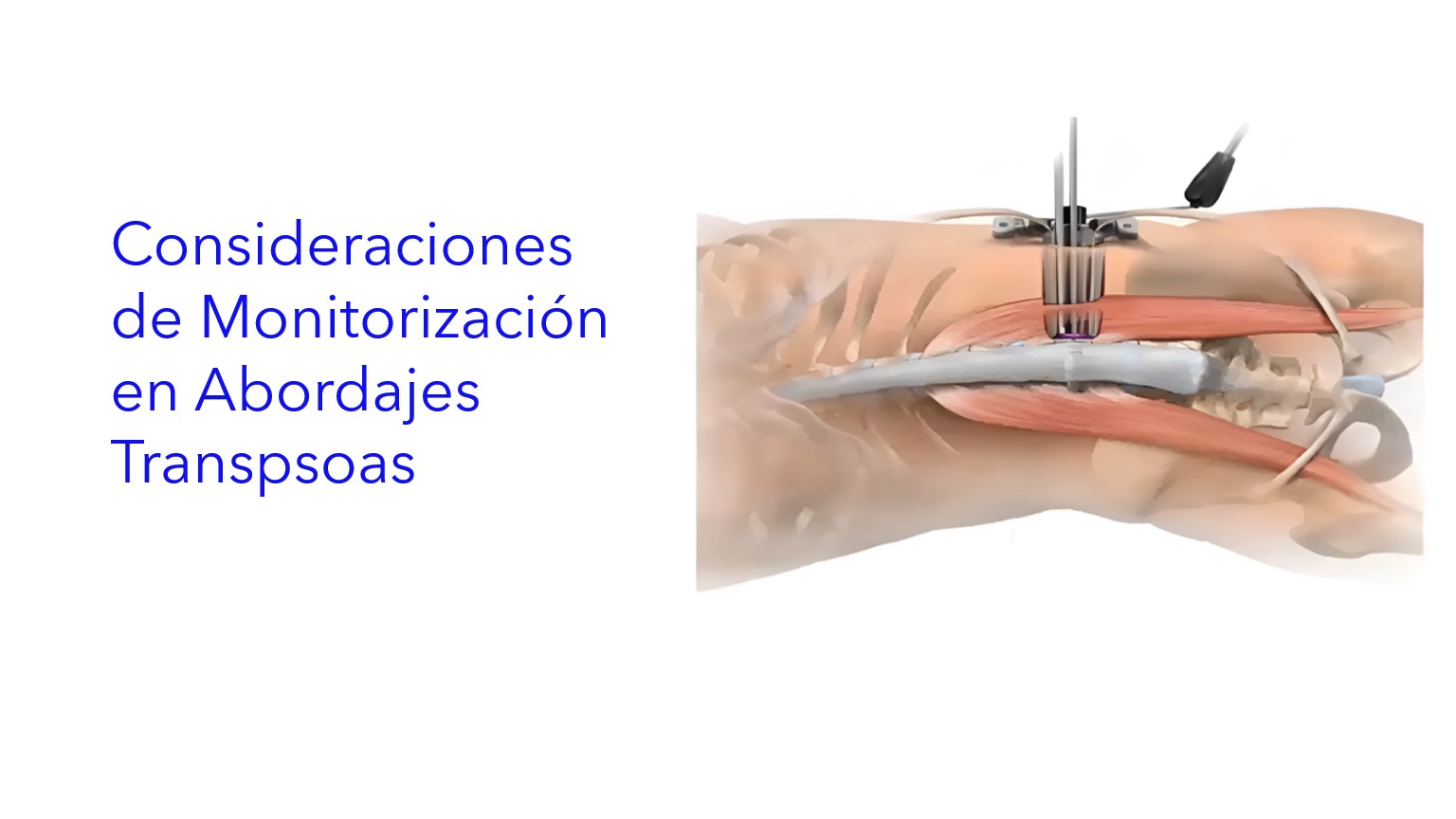 Consideraciones de Monitorización en Abordajes Transpsoas . | Considerações de Monitoramento nas Abordagens Transpsoas . | Monitoring Considerations in Transpsoas Approaches .